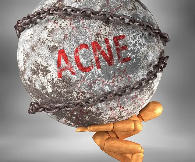 🌟 Acne Uncovered: Understanding Breakouts & Taking Back Your Confidence